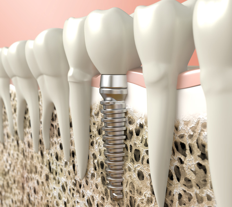 dental implants in lively